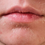 Da khô là gì ? Nguyên nhân khiến da mặt bị khô và mẹo chăm sóc cho da khô